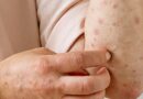 Mpox: mesmo sem casos, Amapá reforça orientações de prevenção